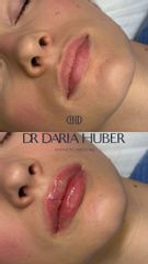 Pierwszorazowe modelowanie ust kwasem hialuronowym