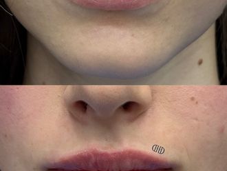 Powiększanie ust kwasem hialuronowym przed i po - 877539