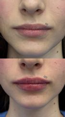 Modelowanie ust oraz symetryzacja brody kwasem hialuronowym