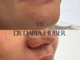 Powiększanie ust kwasem hialuronowym przed i po - 877540