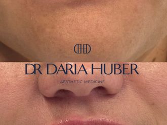 Powiększanie ust kwasem hialuronowym przed i po - 877541