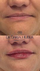 Modelowanie ust kwasem hialuronowym