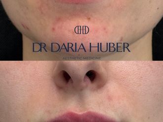 Powiększanie ust kwasem hialuronowym przed i po - 877542