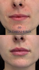 Modelowanie ust kwasem hialuronowym