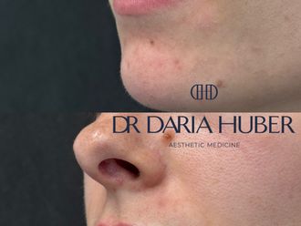 Powiększanie ust kwasem hialuronowym przed i po - 877543