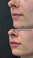 Modelowanie ust kwasem hialuronowym