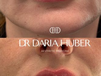 Powiększanie ust kwasem hialuronowym przed i po - 877544