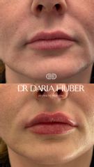 Modelowanie ust kwasem hialuronowym