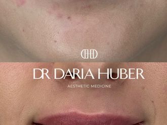 Powiększanie ust kwasem hialuronowym przed i po - 877546