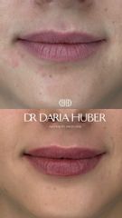 Modelowanie ust kwasem hialuronowym