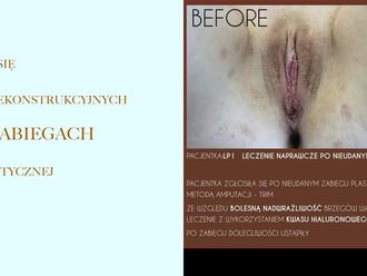 Plastyczna operacja pochwy (Waginoplastyka) - 658375