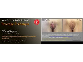 Plastyka warg sromowych metoda Dewedge