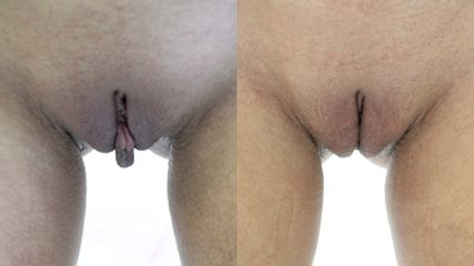 Labioplastyka - dr Dawid Serafin Serafin Clinic