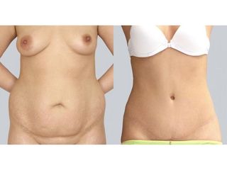 Abdominoplastyka - przed i po