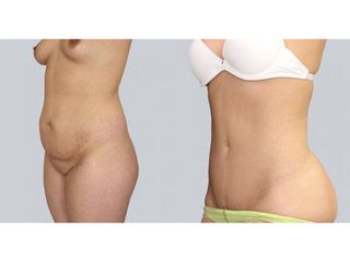 Abdominoplastyka - przed i po