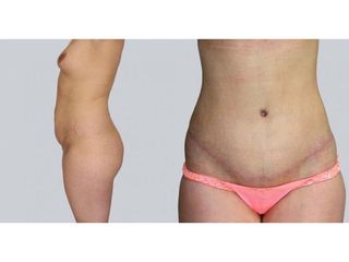 Abdominoplastyka - przed i po