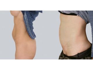 Abdominoplastyka - przed i po