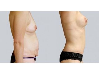 Abdominoplastyka i powiększanie piersi - przed i po