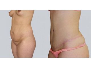 Abdominoplastyka - przed i po