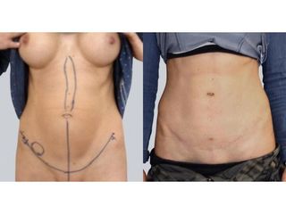 Abdominoplastyka - przed i po