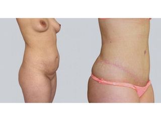 Abdominoplastyka - przed i po