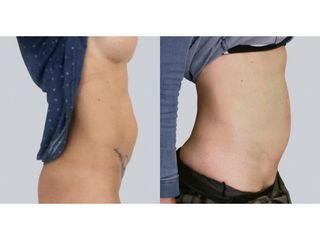Abdominoplastyka - przed i po