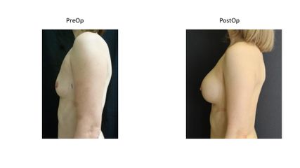 Powiększanie biustu - dr n. med. Kamil Pietrasik