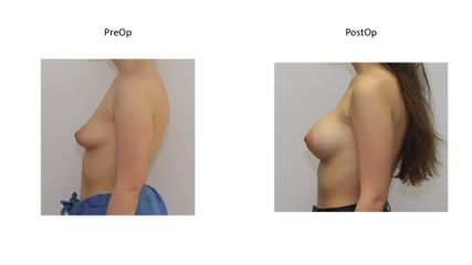 Powiększanie biustu - dr n. med. Kamil Pietrasik