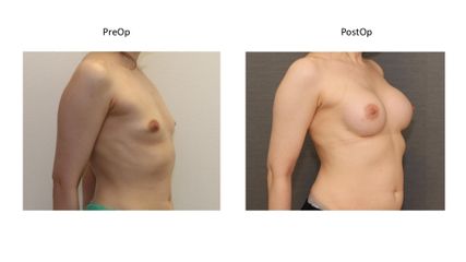 Powiększanie biustu - dr n. med. Kamil Pietrasik