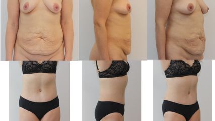 Abdominoplastyka - dr n. med. Kamil Pietrasik