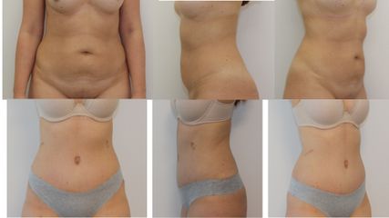 Abdominoplastyka - dr n. med. Kamil Pietrasik