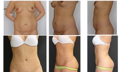 Abdominoplastyka - dr n. med. Kamil Pietrasik