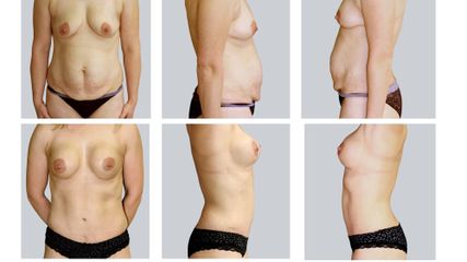 Abdominoplastyka + powiększenie piersi - dr n. med. Kamil Pietrasik
