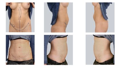 Abdominoplastyka - dr n. med. Kamil Pietrasik