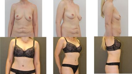 Abdominoplastyka - dr n. med. Kamil Pietrasik