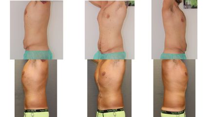 Abdominoplastyka - dr n. med. Kamil Pietrasik