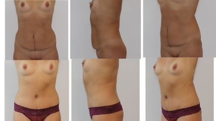 Abdominoplastyka - dr n. med. Kamil Pietrasik