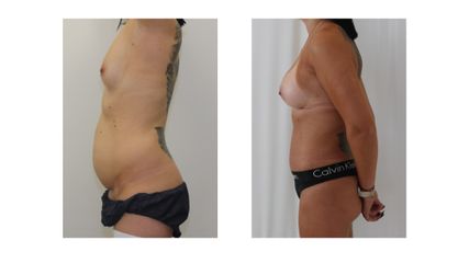 Abdominoplastyka - dr n. med. Kamil Pietrasik