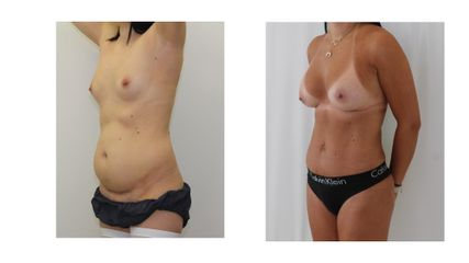 Abdominoplastyka - dr n. med. Kamil Pietrasik