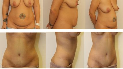 Abdominoplastyka - dr n. med. Kamil Pietrasik