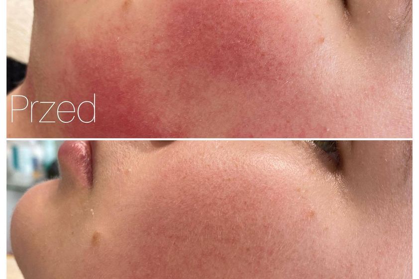 Laserowe zabiegi dermatologii estetycznej przed i po - 850390