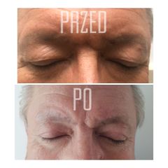 Blefaroplastyka - przed i po