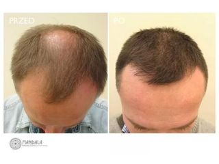 Przeszczep włosów - przed i po
