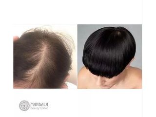 Przeszczep włosów - przed i po