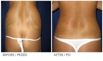 coollipo2