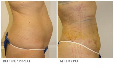 coollipo3