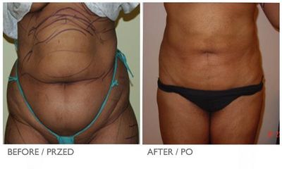 coollipo4