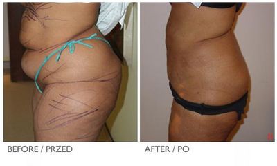 coollipo5