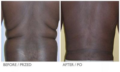 coollipo6