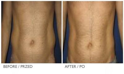 coollipo7